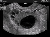 PCOS picture of ovary