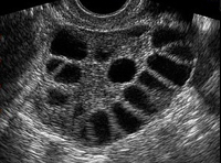 PCOS ultrasound picture of ovary