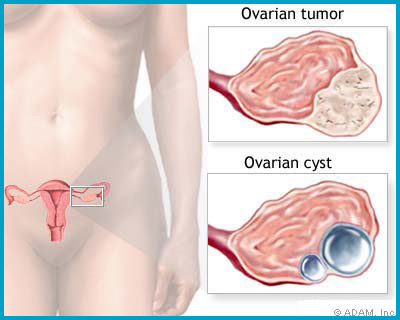 Ovarian Surgery